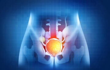 Prostate cancer stock image 3D illustration